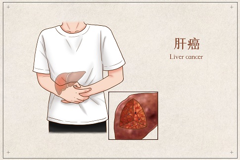 1653321154268908.jpg 攝圖網(wǎng)_401794893_banner_肝癌醫(yī)療插畫(huà)(企業(yè)商用).jpg