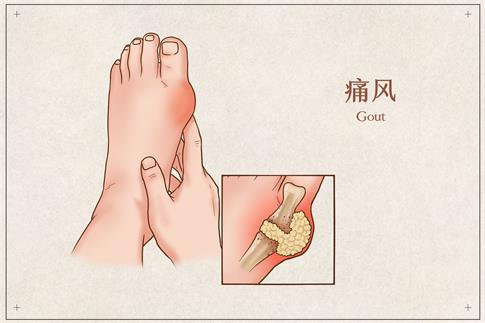 1681525302425123.jpg 攝圖網(wǎng)_401794683_banner_痛風(fēng)醫(yī)療插畫(huà)(企業(yè)商用).jpg