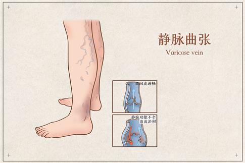1701387452406509.jpg 攝圖網_401799108_靜脈曲張醫療插畫(企業商用).jpg